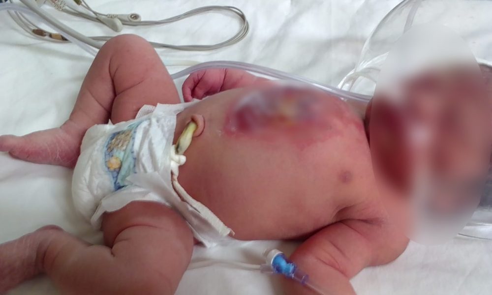 Bebé sufre quemaduras en Centro de Salud de Tolimán - Noticias de Querétaro